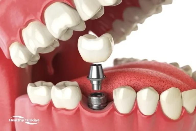 How All-on-6 Implants in Turkey Offer the Best Value for Full-Arch Restoration