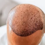 Top-Quality Hair Transplant