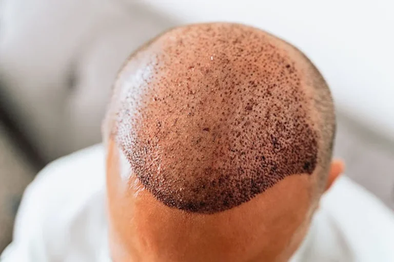 Top-Quality Hair Transplant